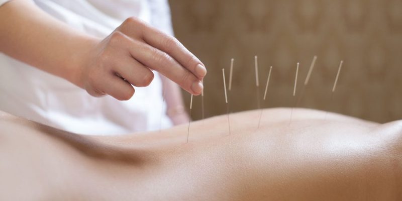 Should You Use Acupuncture for Weight Loss?