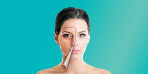 Home Remedies For Acne Scar