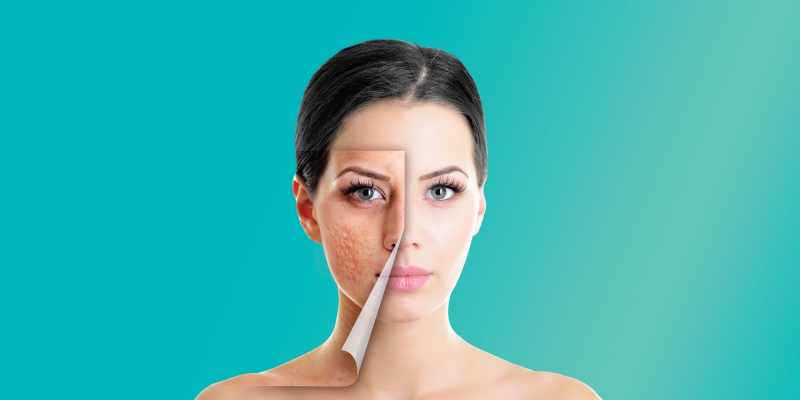 Home Remedies For Acne Scar