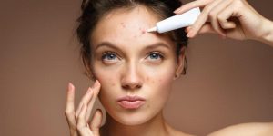 How to Get Rid of Acne Using Lighter Medications And Natural Remedies
