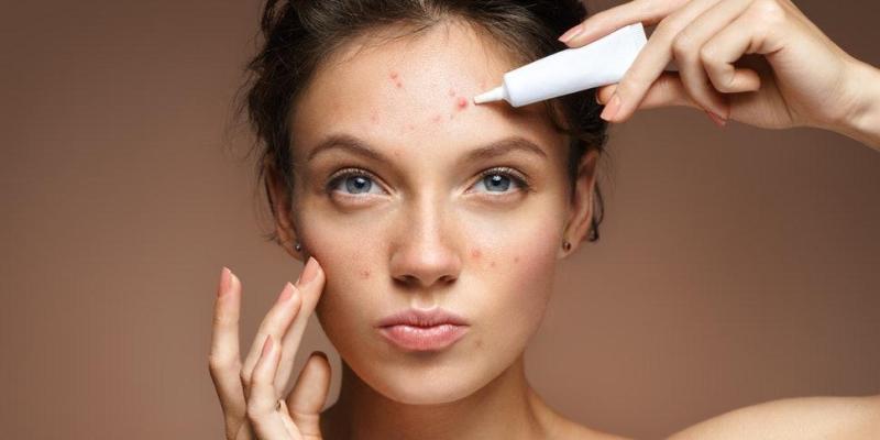 How to Get Rid of Acne Using Lighter Medications And Natural Remedies