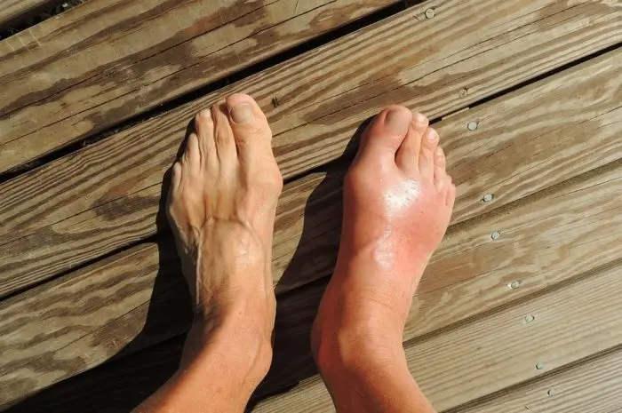 Easy Ways to Manage Gout Symptoms